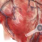 transient pacemaker