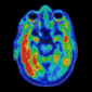 Biomarker of cognitive decline seen in brain scan