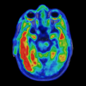 Biomarker of cognitive decline seen in brain scan