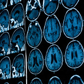 brain tumor