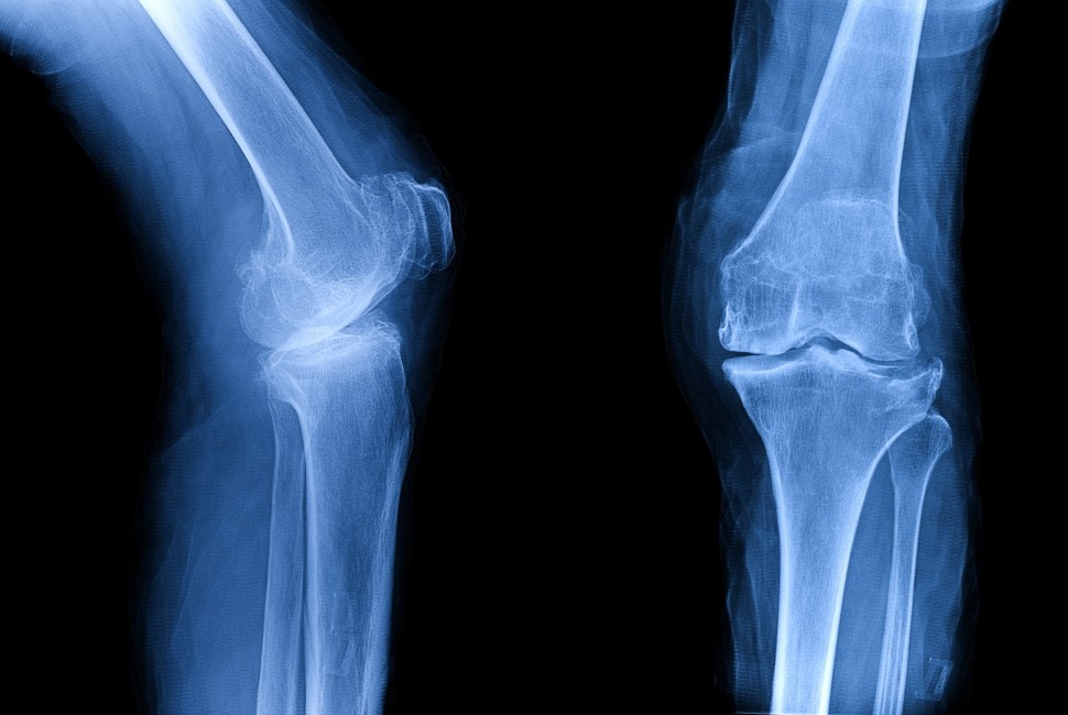 ajánlások az osteoarthritis kezelésére csigolya artrózis tünetei és kezelése