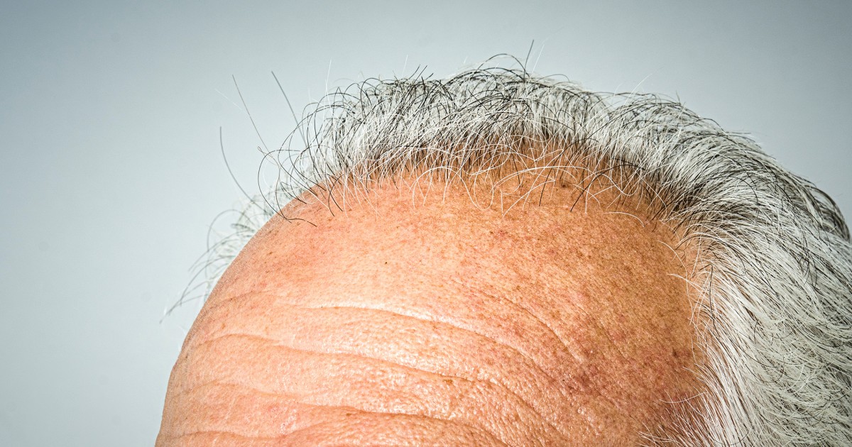 Stuck stem cells linked with hair graying Study