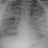 X-Ray image of lungs with ARDS. Credit: NIH