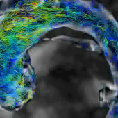 aorta
