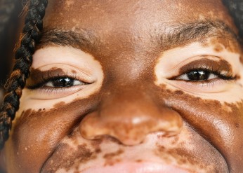 closeup of the face of someone with vitiligo