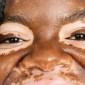 closeup of the face of someone with vitiligo