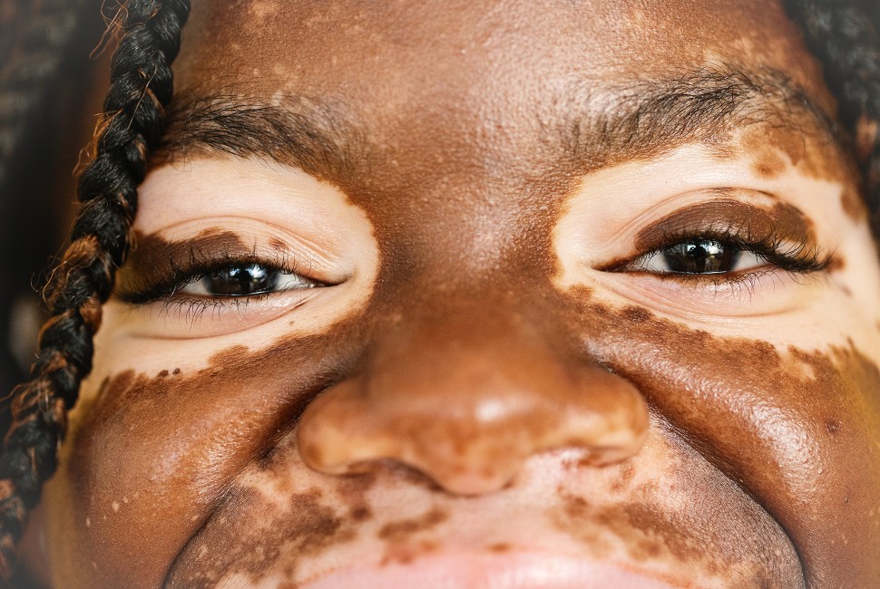 closeup of the face of someone with vitiligo