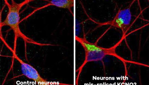 Side-by-side image shows control neurons from the study (left) compared to neurons from the study with the mis-spliced KCNQ2 gene.  