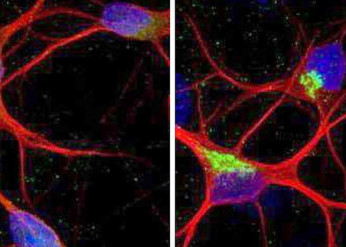 ALS and FTD explanation and possible treatment
